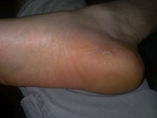 … a tu prawa pięta…