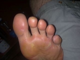 … a tak prezentowała się stopa lewa…